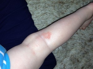 He also got/gets all kinds of fun rashes and eczema. 